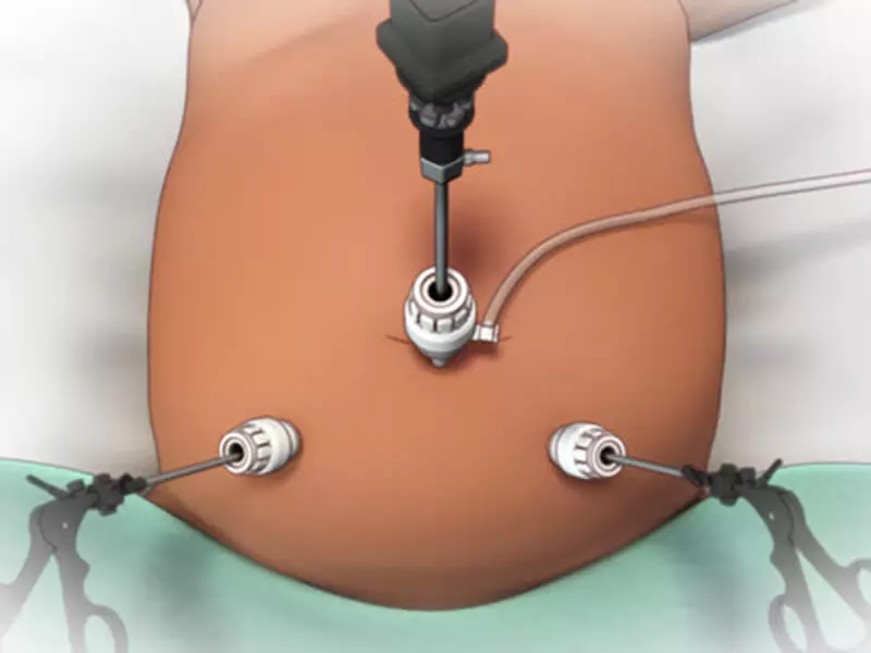 Laparoscopic Surgery